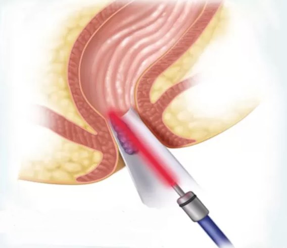 cirugia laser anal en guadalajara