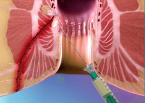 operacion de fistula anal en guadalajara