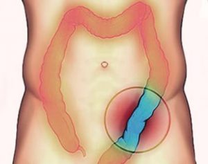 tratamiento de colitis en guadalajara