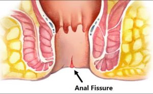 tratamiento de fisura anal en guadalajara