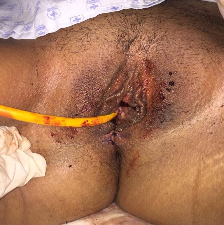 cirugia rectovaginal en guadalajara