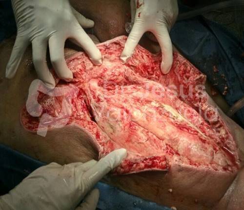 absceso perianal con extension a muslo tratamiento en jalisco