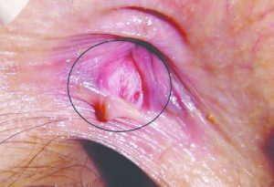 tratamiento de fisura anal en guadalajara