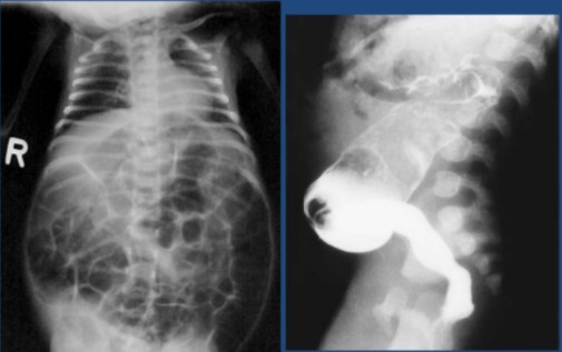 colitis ulcerosa tratamiento en zapopan