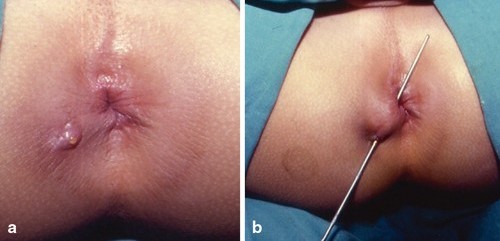 cirugia de fistula perianal guadalajara