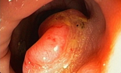 tratamiento de cancer de colon en jalisco